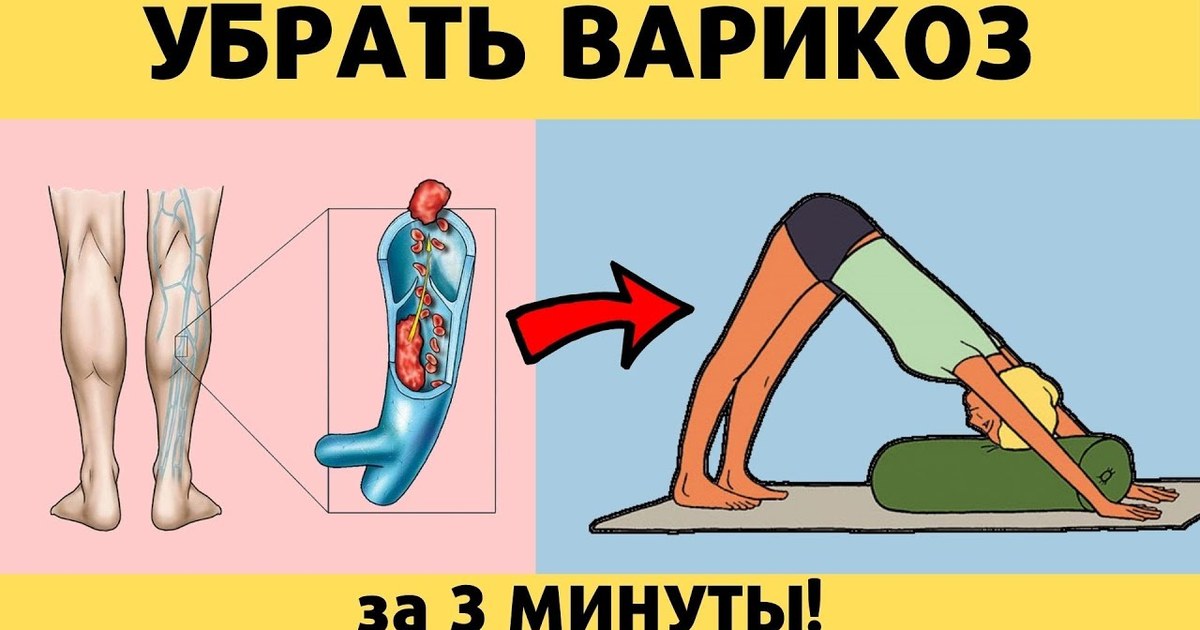 упражнения от варикоза